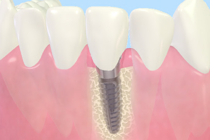 インプラント治療