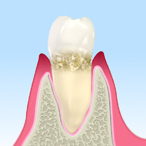 軽度の歯周病